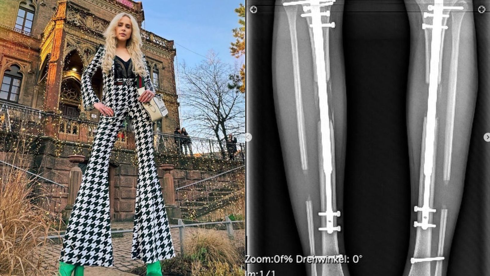 Cirurgia 'Frankenstein': entenda procedimento de milhões que fez modelo ganhar 14 cm