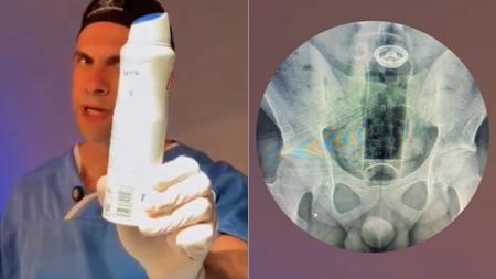 Médico faz alerta sobre objetos introduzidos no reto