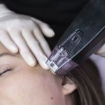 Abdominoplastia + Morpheus + bioestimuladores: o trio perfeito contra a flacidez corporal