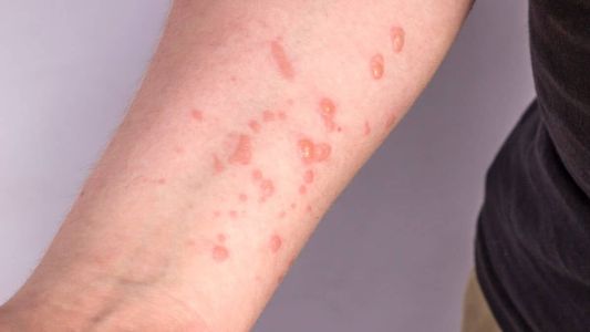 Mpox causa irrupções na pele