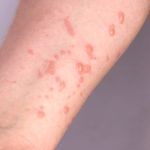 Casos de mpox sobem para 13 em Minas Gerais