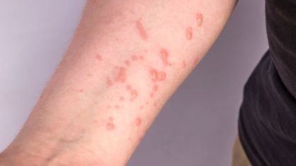 Mpox causa irrupções na pele