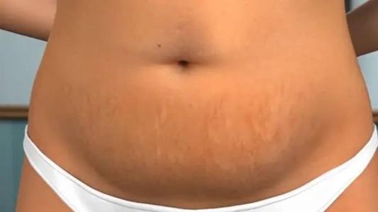 Muitas pessoas procuram a lipoaspiração para melhorar a autoestima