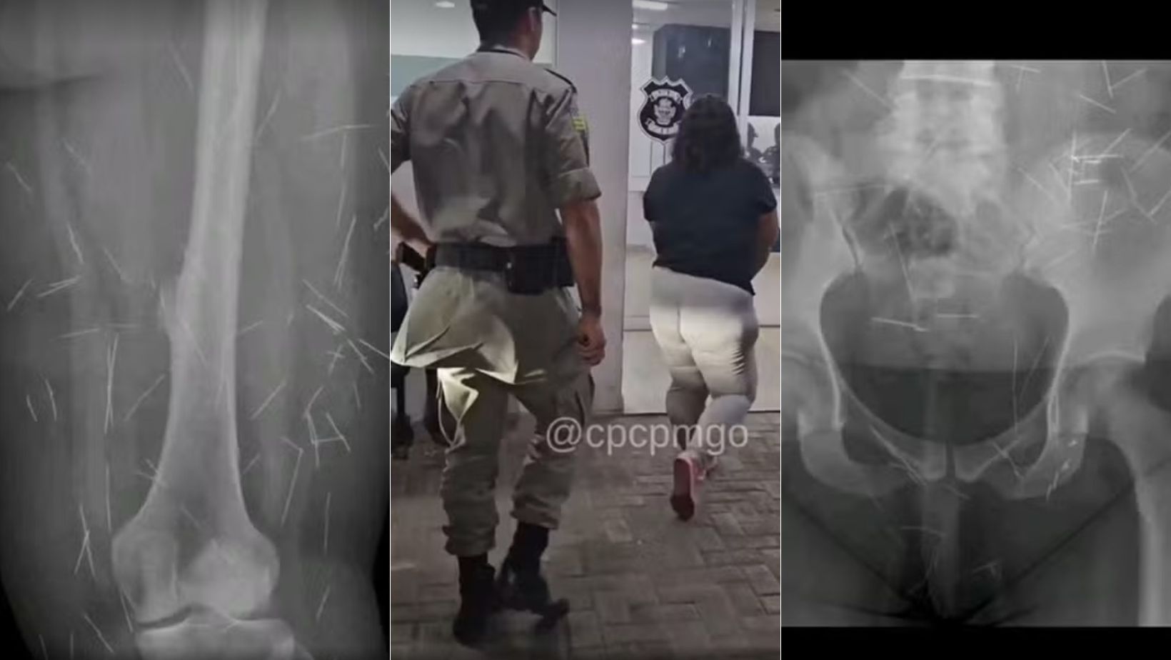 Mulher com mais de 200 agulhas pelo corpo é presa suspeita de aplicar golpe para conseguir doações