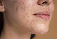 Páscoa: chocolate pode causar acne? Médico responde