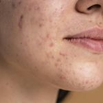 Páscoa: chocolate pode causar acne? Médico responde
