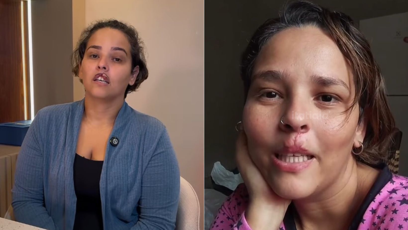 Mulher que teve lábio arrancado por cachorro passa por 2ª cirurgia de reconstrução; imagens são sensíveis
