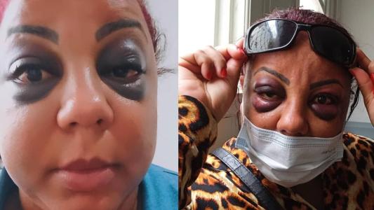 Mulher recebeu vários socos nos olhos e perdeu 60% da visão esquerda