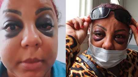 Mulher recebeu vários socos nos olhos e perdeu 60% da visão esquerda