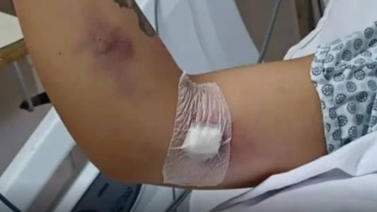 Mulher teve teve a mão e o punho esquerdos amputados