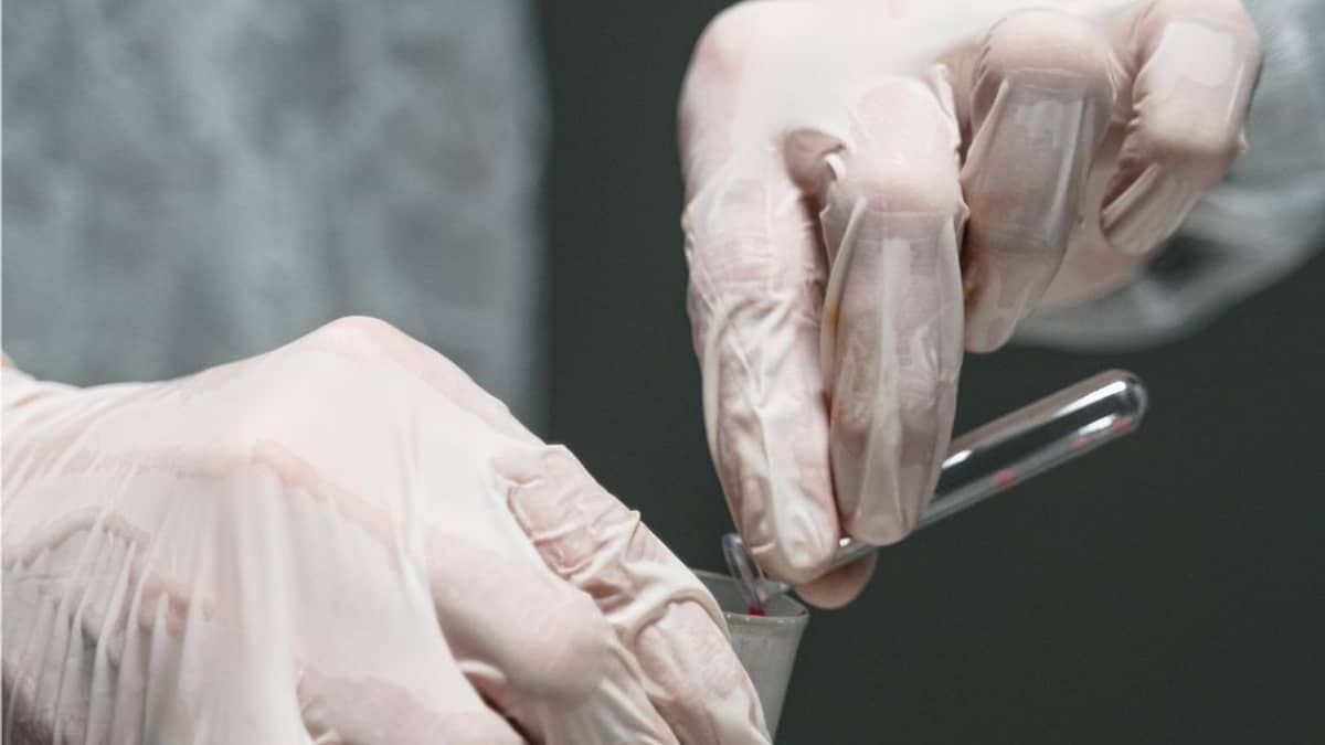 Ouro Preto realiza mutirão de testagem contra hepatites virais