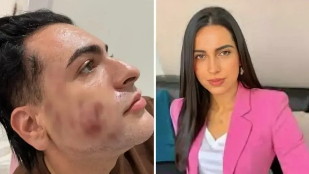 Peeling de Fenol: Justiça marca audiência que decidirá se influenciadora irá a júri popular