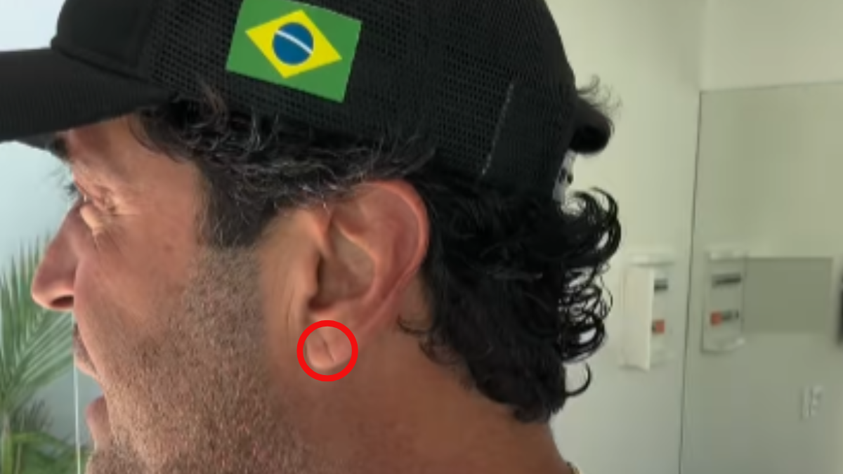 Sinal de Frank é fator de risco para infarto? Cardiologista Roberto Kalil esclarece
