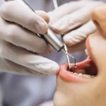 Implantes dentários: o que são e quais os seus benefícios 