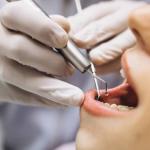 Implantes dentários: o que são e quais os seus benefícios
