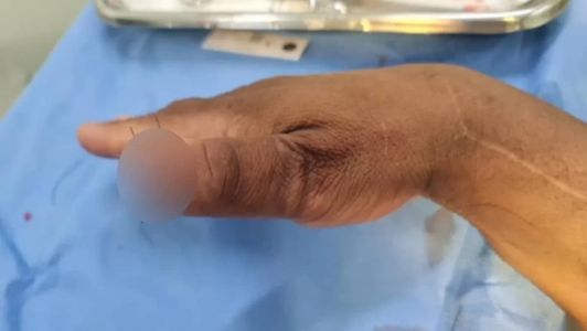 O homem foi atendido mas não conseguiu recuperar o dedo