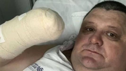 O humorista teve a mão direita amputada
