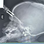 Criança de um ano cai da cama e fica com carregador cravado na testa em Minas