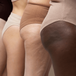O que é lipedema? Especialista explica sintomas e como identificar