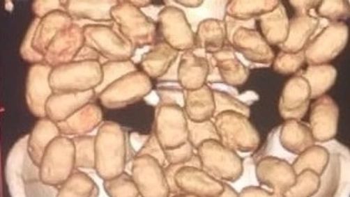 O raio-x apontou mais de 50 cápsulas de cocaína em cada passageiro.