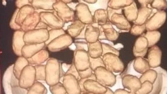 O raio-x apontou mais de 50 cápsulas de cocaína em cada passageiro.
