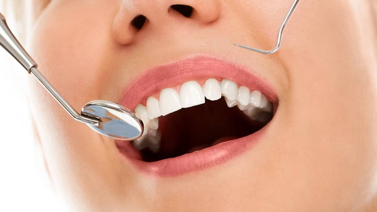 O que são Implantes Dentários e quais os seus benefícios 