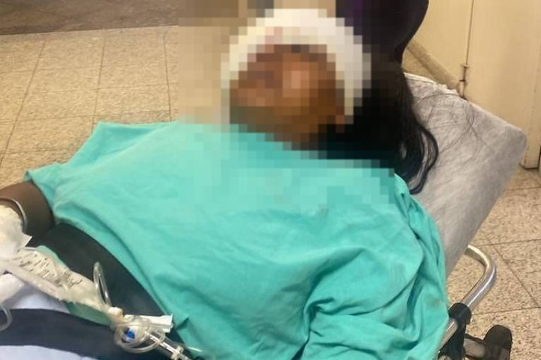 Mulher atingida no olho por tiro da PM em SP reconstrói parte da face