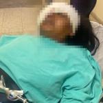 Mulher atingida no olho por tiro da PM em SP reconstrói parte da face