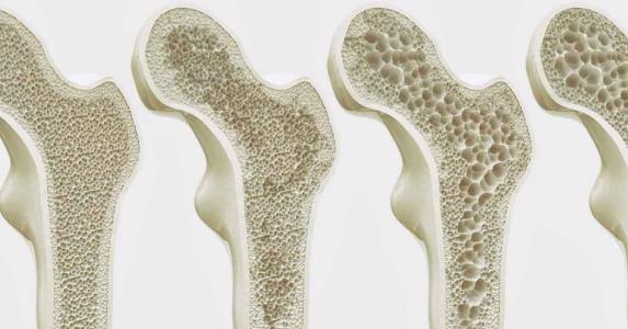 Osteoporose são 'poros' nos ossos