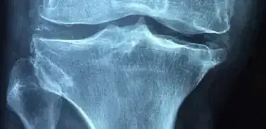 Osteoporose: reposição de cálcio e cuidados com a coluna ajudam no controle da doença