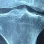 Osteoporose: reposição de cálcio e cuidados com a coluna ajudam no controle da doença