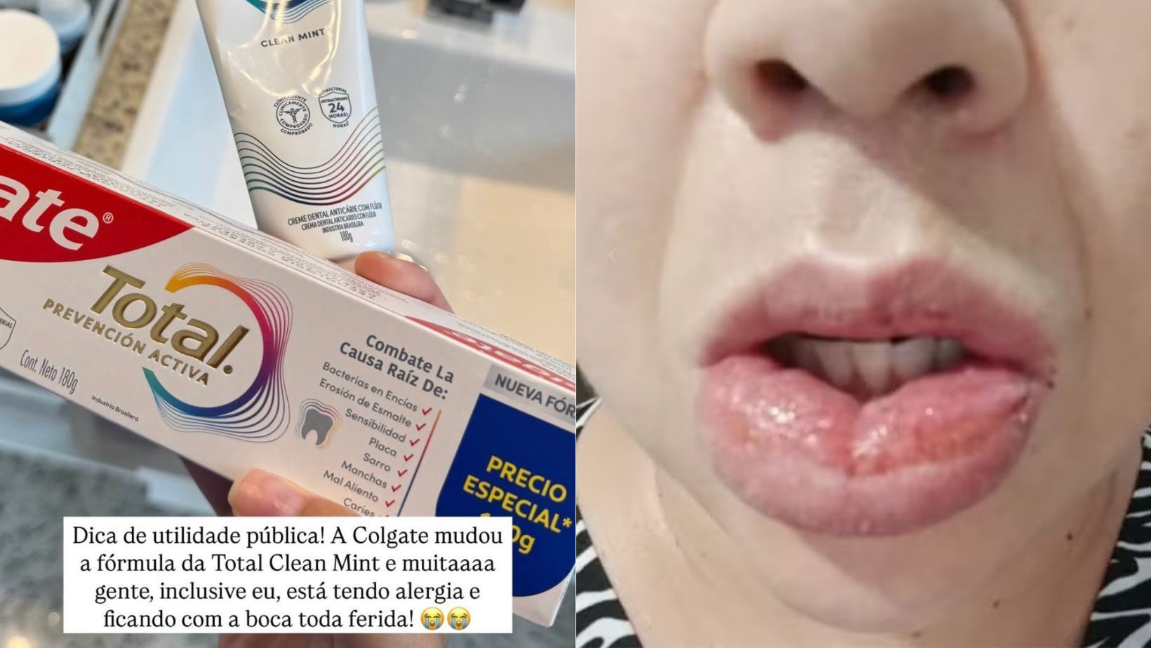 Pasta de dente da Colgate causa reação alérgica grave e mulher diz que irá processar empresa