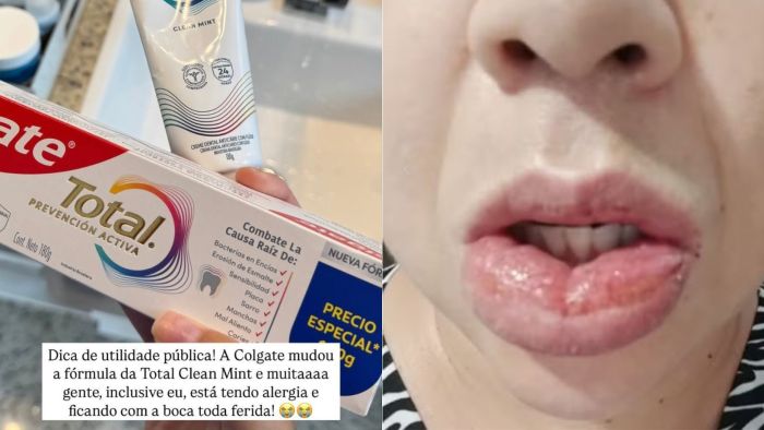 Pasta de dente da Colgate causa reação alérgica grave e mulher diz que irá processar empresa