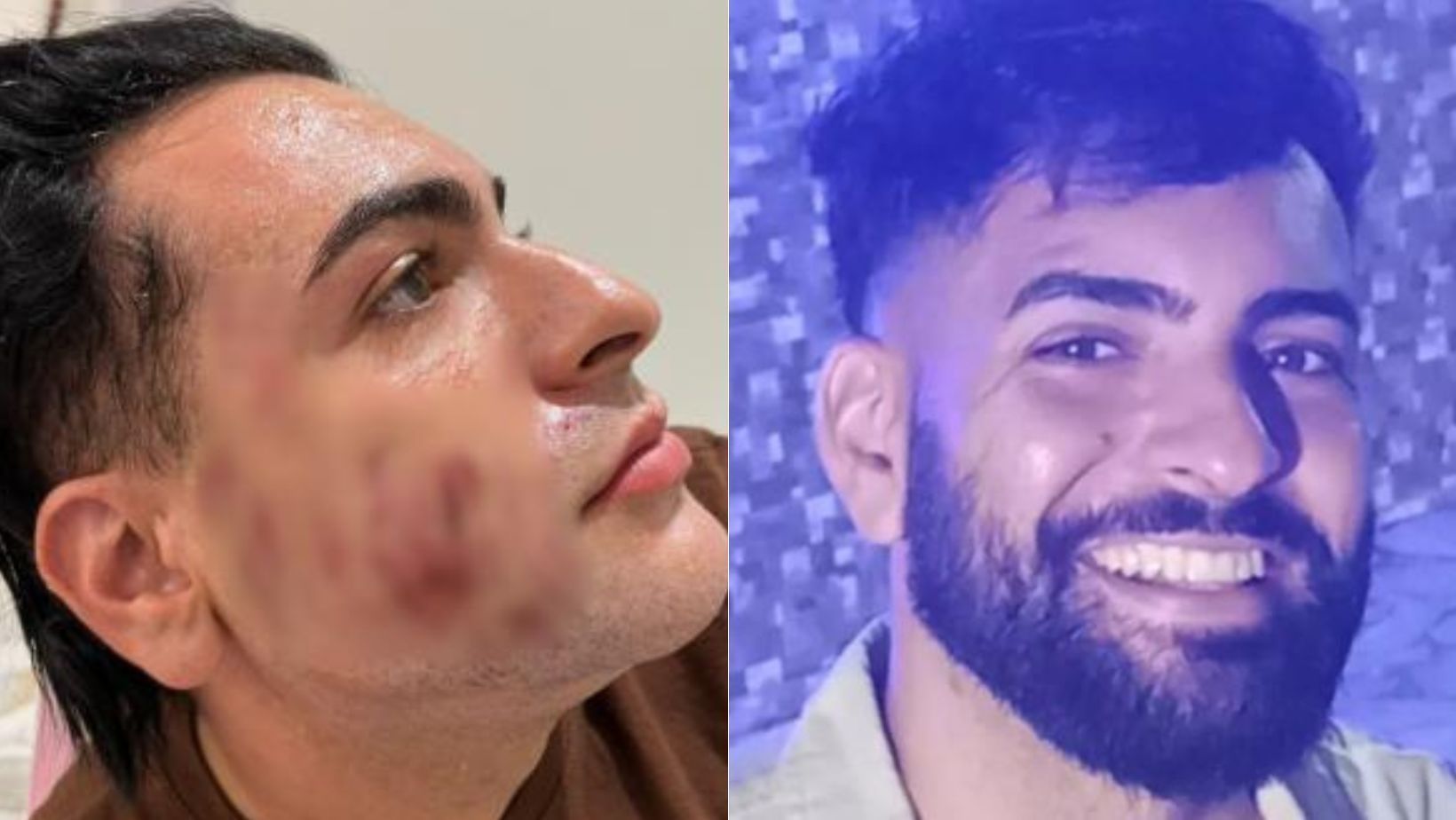 Peeling de fenol: empresário morreu devido a 'edema pulmonar agudo' ao inalar produto, diz IML