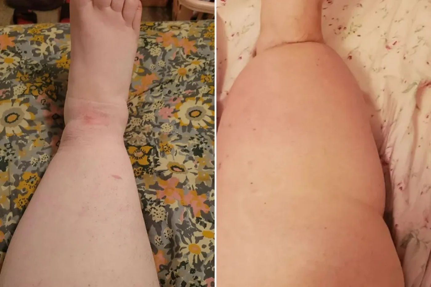 Mulher que sofria bullying por ter 'pernas de tronco de árvore' descobre doença
