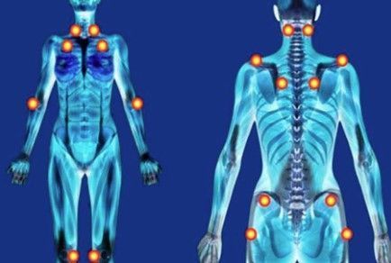 Pontos do corpo onde aparecem os gatilhos da fibromialgia