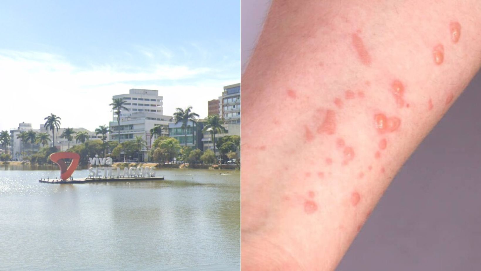 Prefeitura de Sete Lagoas confirma suspeita de dois casos de mpox; veja sintomas e prevenção