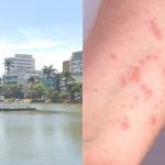 Prefeitura de Sete Lagoas confirma suspeita de dois casos de mpox; veja sintomas e prevenção