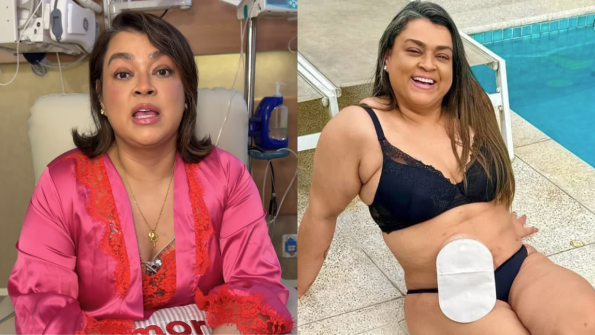 Preta Gil usará bolsa de colostomia definitiva; entenda como funciona o dispositivo