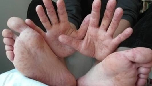 Principal caracteristica da Síndrome Mão-Pé-Boca é o surgimento de manchas avermelhadas no corpo