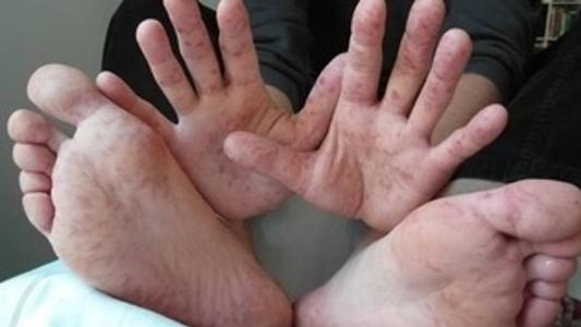 Principal caracteristica da Síndrome Mão-Pé-Boca é o surgimento de manchas avermelhadas no corpo