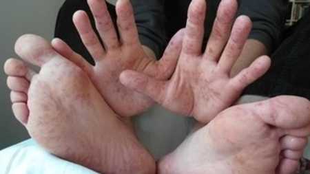 Principal caracteristica da Síndrome Mão-Pé-Boca é o surgimento de manchas avermelhadas no corpo