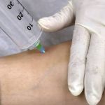 Processos não comprovaram eficácia médica da ozonioterapia, diz à CNN gerente da Anvisa