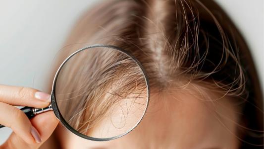 Queda de cabelo: quando devo me preocupar? O que fazer para evitar?