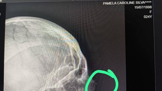 Raio-X de Pamela - imagem cedida pela Vítima