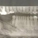 Paciente revela que perdeu parte do maxilar e contraiu bactéria em clínica odontológica em BH: 'não posso rir em público'