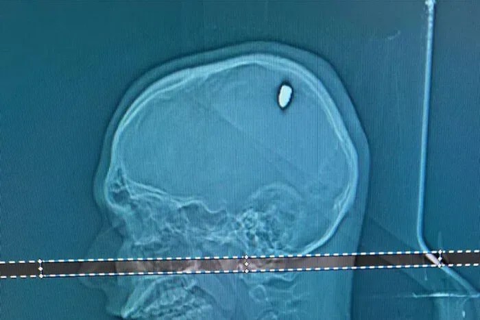 Em praia de Cabo Frio, mineiro é atingido por bala na cabeça e só descobre 4 dias depois