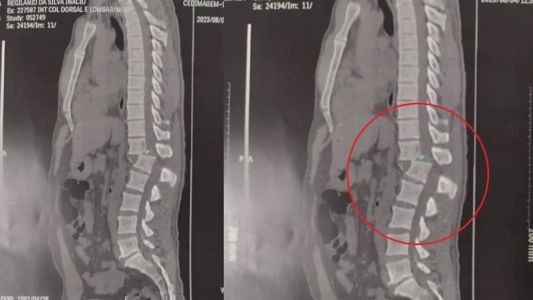 Raio-X mostra lesão na coluna do homem atingido por aparelho de academia