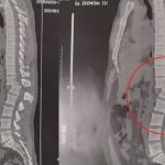 Homem atingido por aparelho de musculação mantém esperança em voltar a andar 