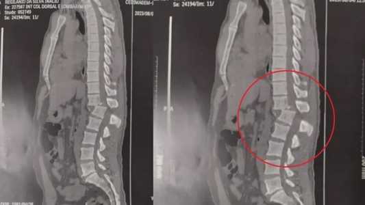 Raio-X mostra lesão na coluna do homem atingido por aparelho de academia
